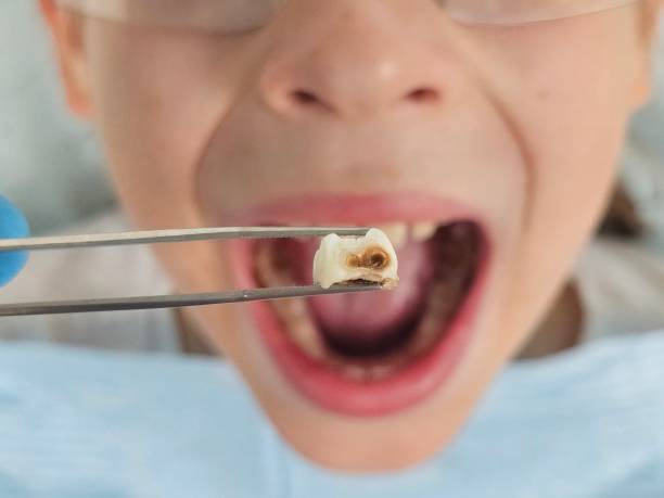 Best Emergency Wisdom Teeth Removal in Harsville, RI