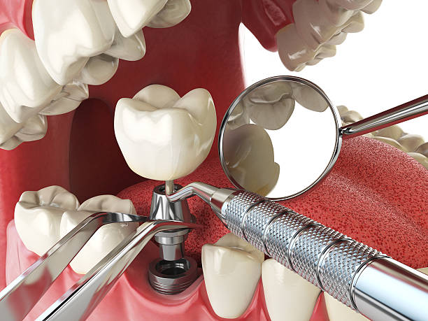 Best Emergency Treatment for Dental Infections or Abscesses in Harsville, RI